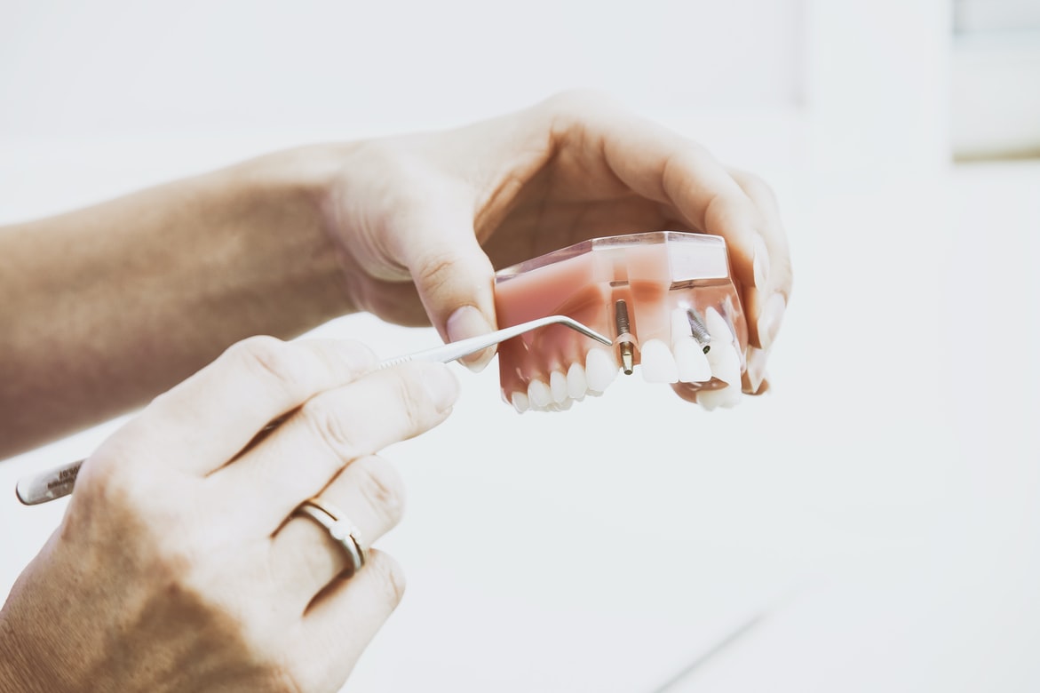 What Are Dental Implants?